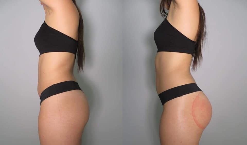 Colombian Butt Lift Before and After