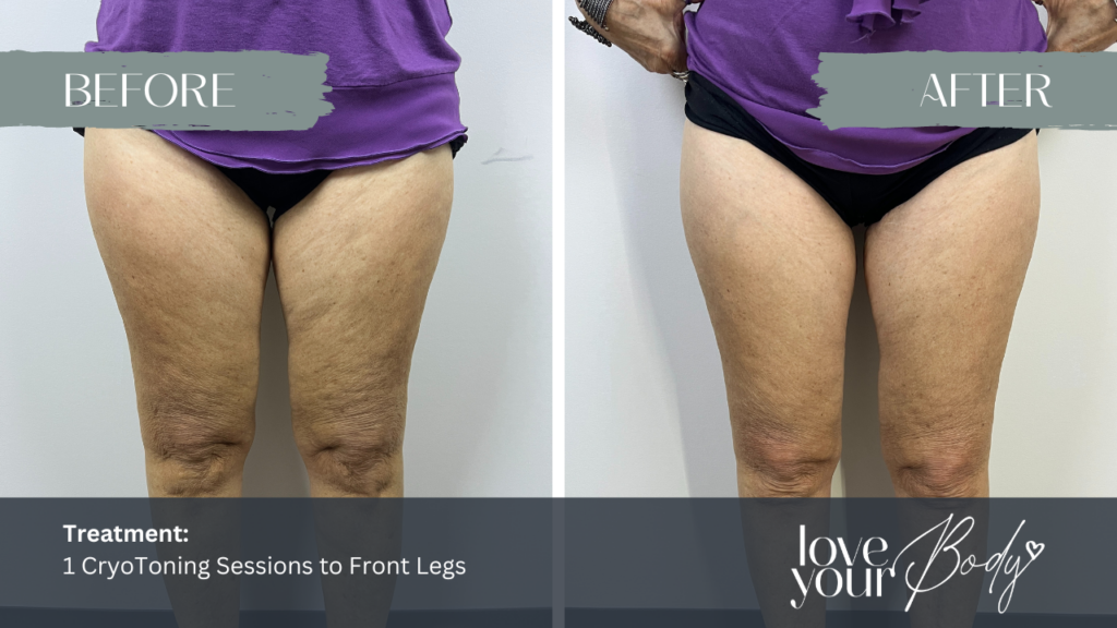 CryoTone Legs Clearwater Love Your Body