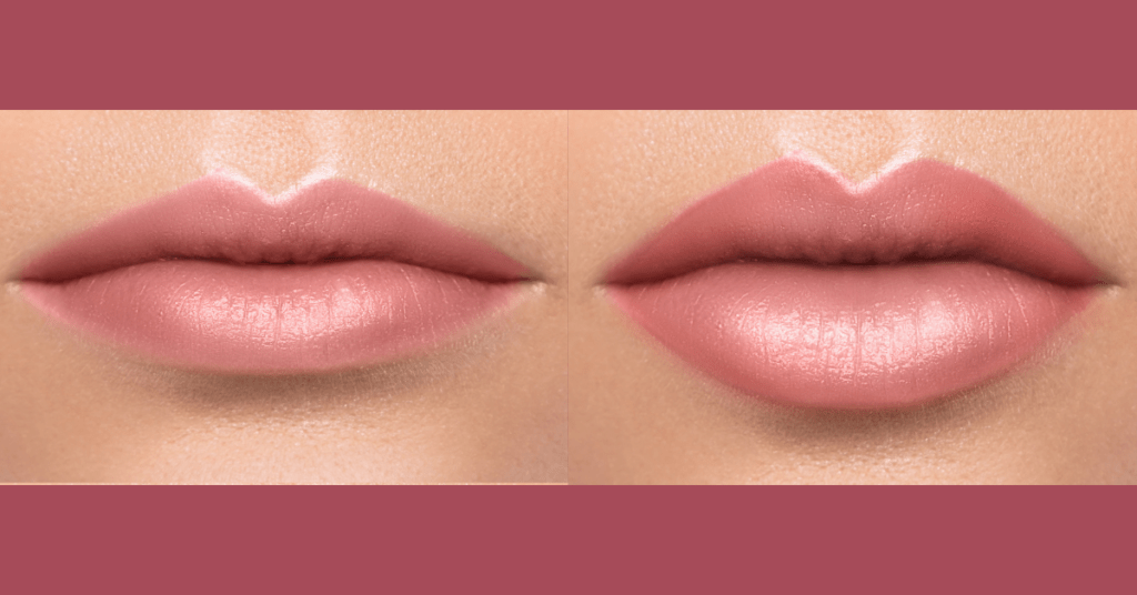 lip filler cosmetic injections in clearwater