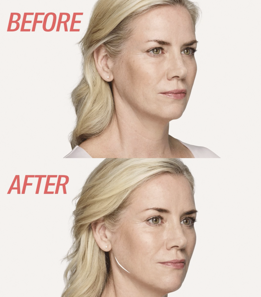 Juvederm facial filler in clearwater before and after jaw line