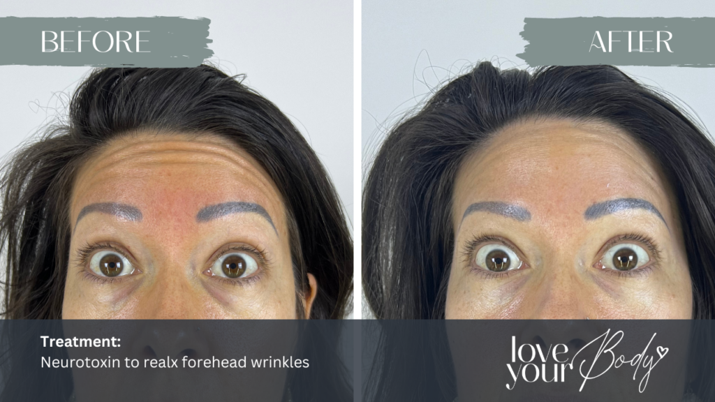 Neurotoxin Forehead Wrinkles - Botox, Dysport | Clearwarer Florida