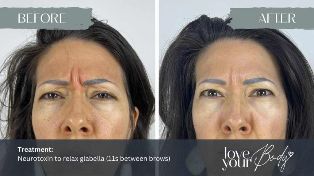 Neurotoxin Glabella Eyebrow 11s - Botox, Dysport | Clearwarer Florida