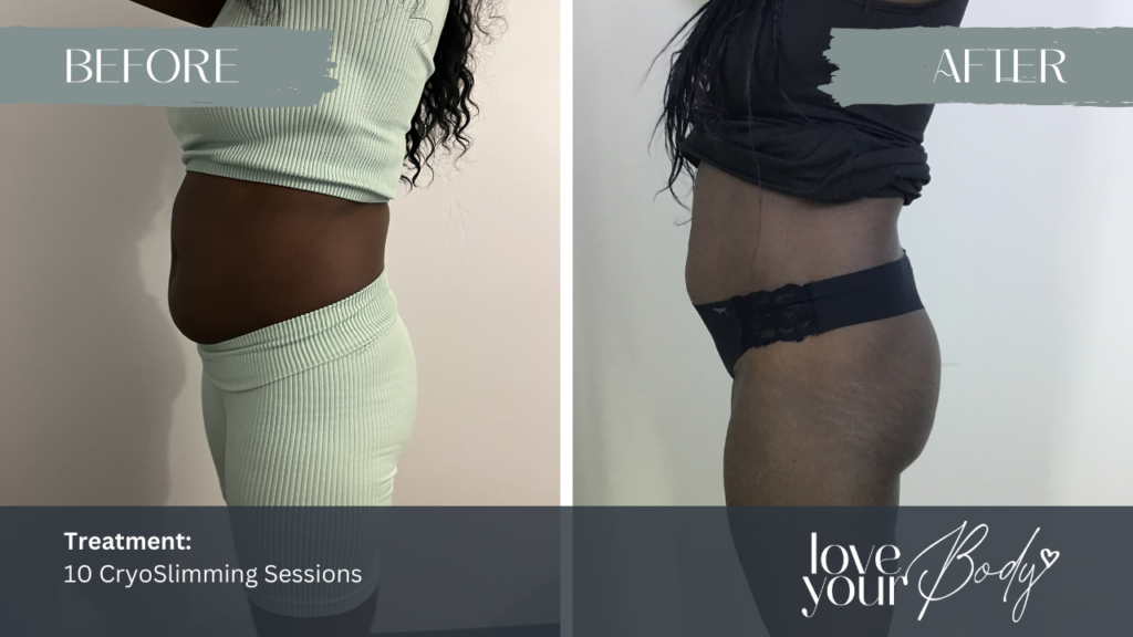 Body Sculpting in Clearwater Before & After