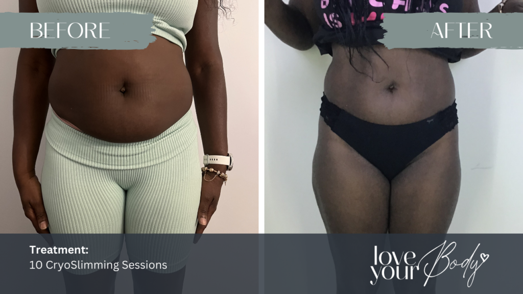 Body Sculpting in Clearwater Before & After 2