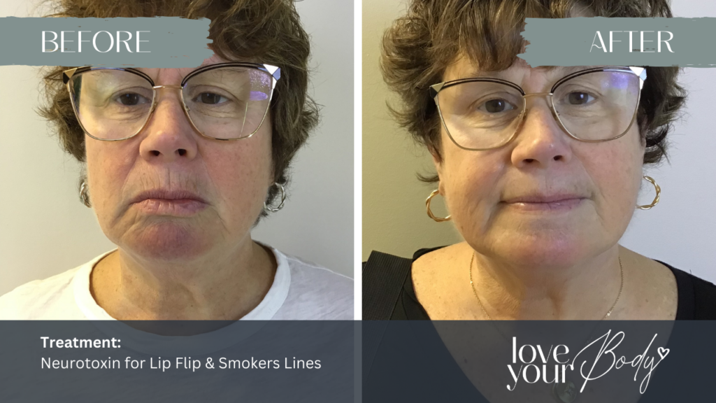 Botox in Clearwater - Lip Flip | Before and After