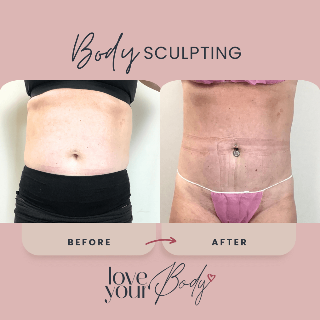 Body Sculpting Results in Clearwater Front View Abdomen - Love Your Body