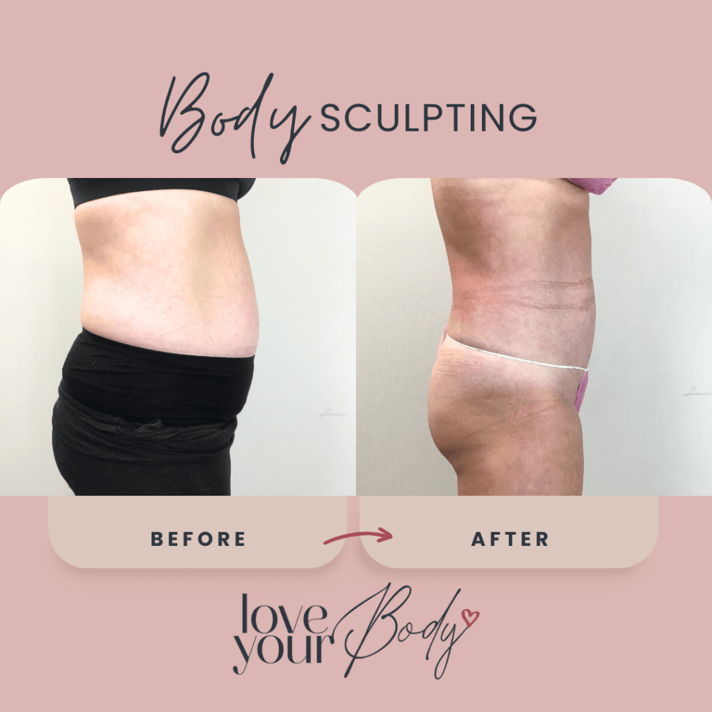Body Sculpting Results in Clearwater Side View 1 - Love Your Body