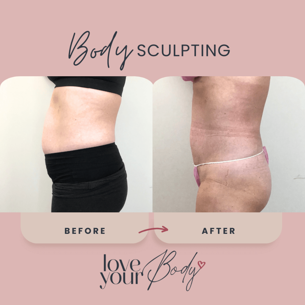 Body Sculpting Results in Clearwater Side View 2 - Love Your Body