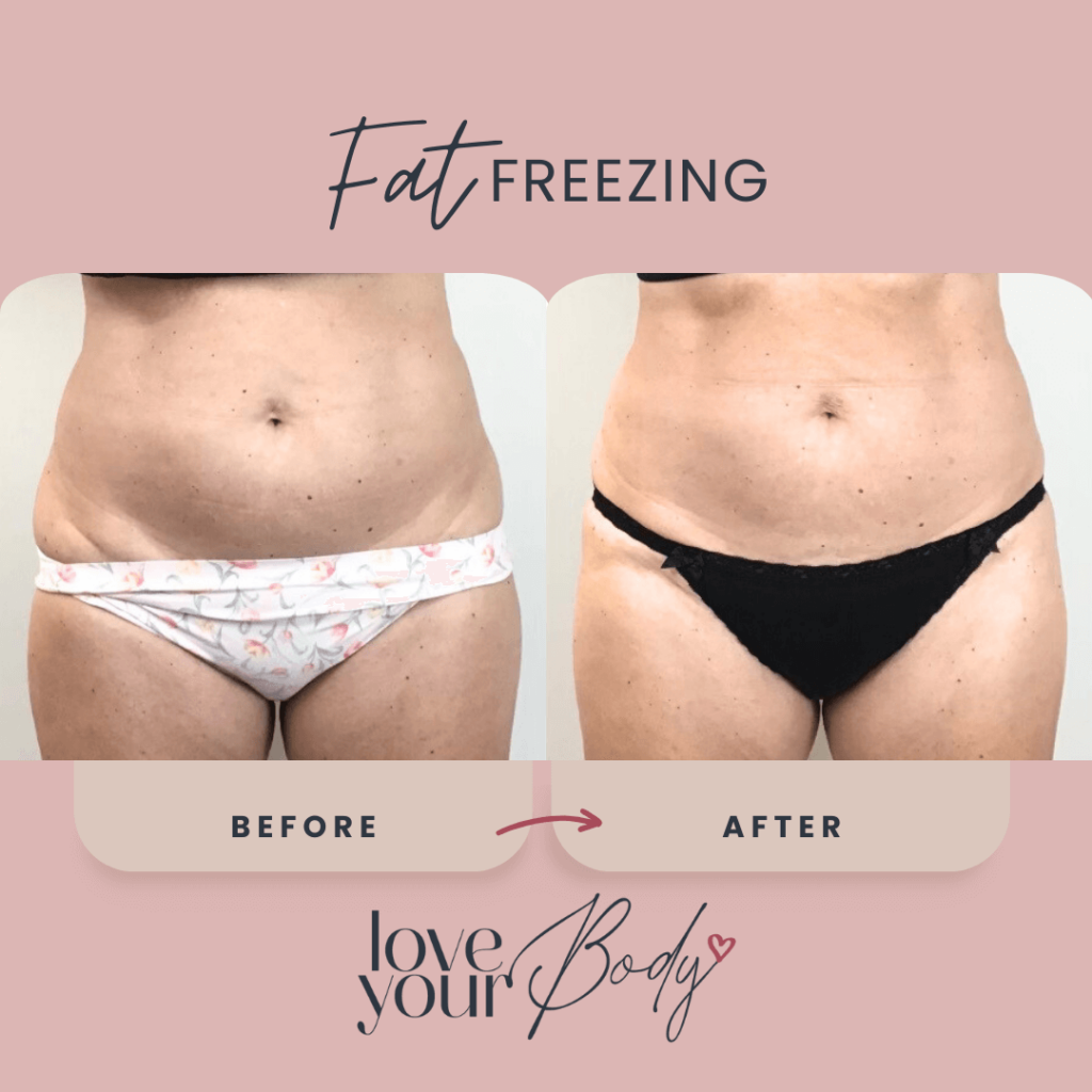 Body Sculpting Before and After at Love Your Body in Clearwater 1