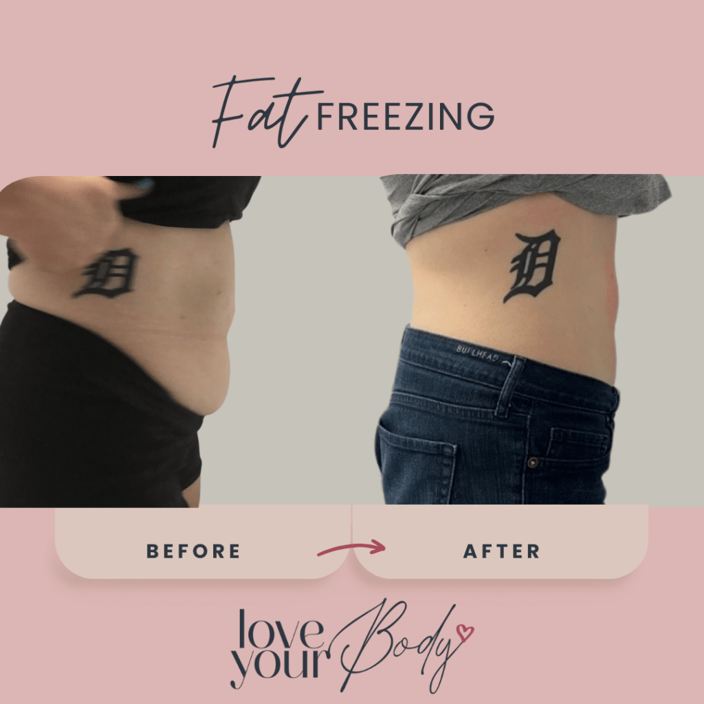Body Sculpting Before and After at Love Your Body in Clearwater 10
