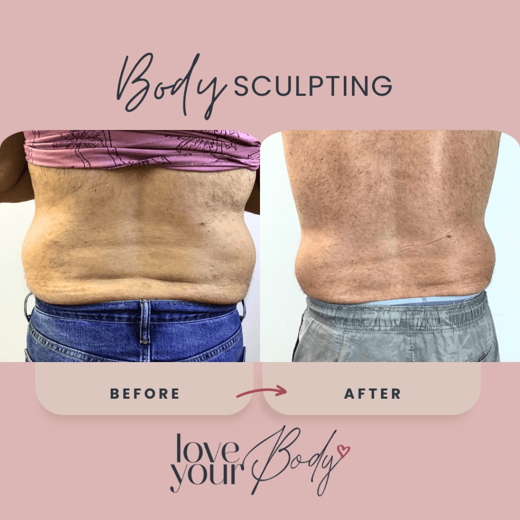 Body Sculpting Before and After at Love Your Body in Clearwater 11