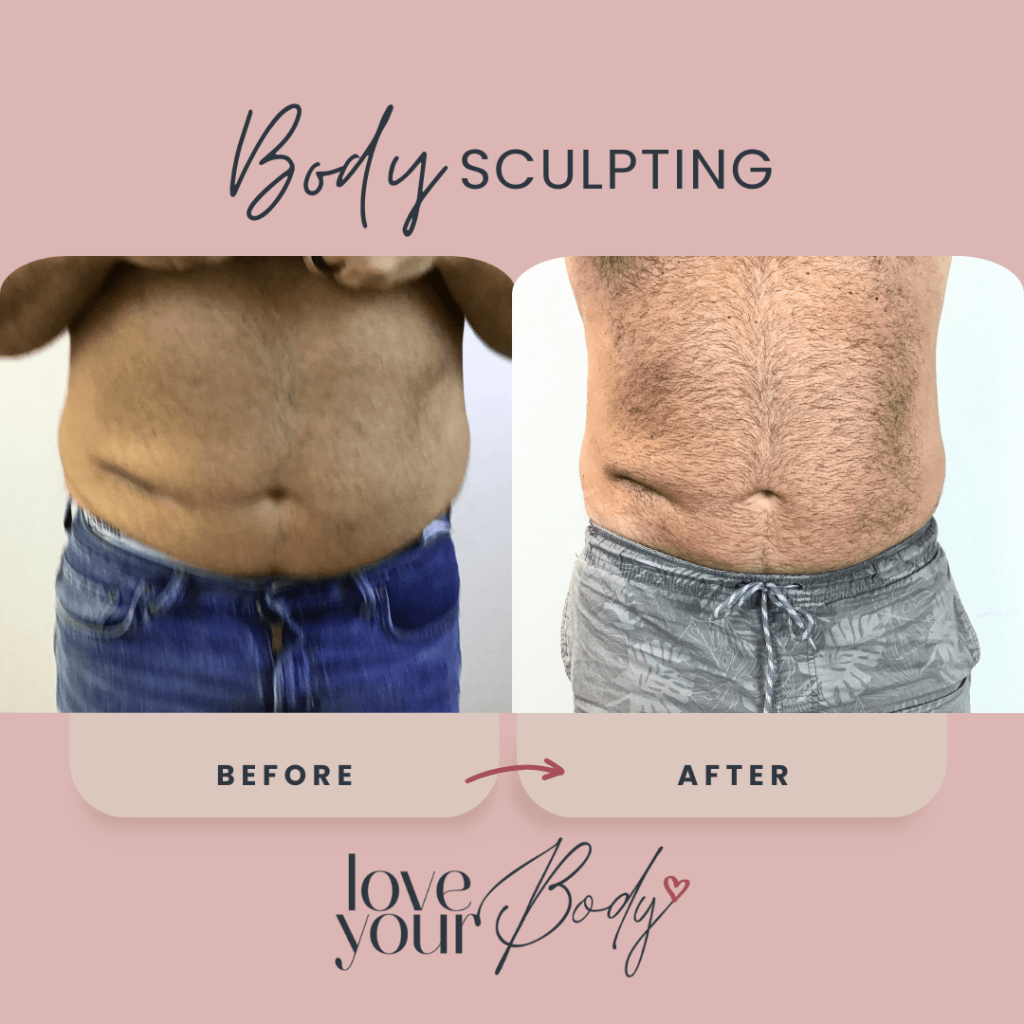 Body Sculpting Before and After at Love Your Body in Clearwater 12