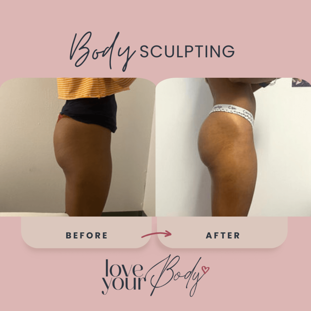 Body Sculpting Before and After at Love Your Body in Clearwater 7