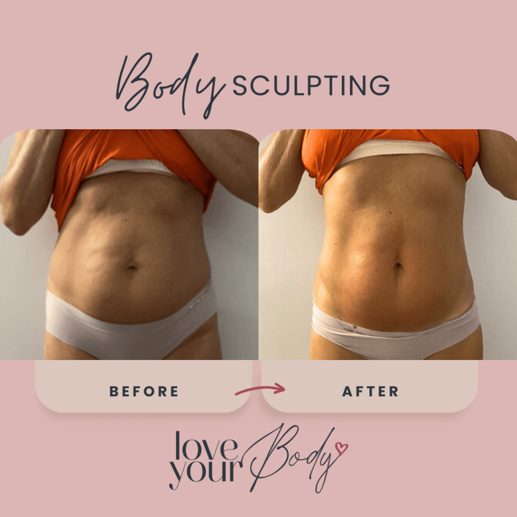 Body Sculpting Before and After at Love Your Body in Clearwater 8