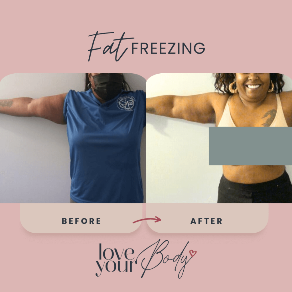 Body Sculpting Arms Before and After at Love Your Body in Clearwater 9