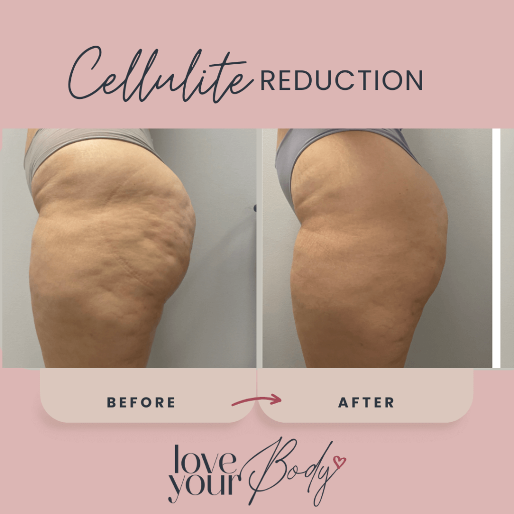 Body Sculpting Cellulite Reduction Before and After at Love Your Body in Clearwater 4
