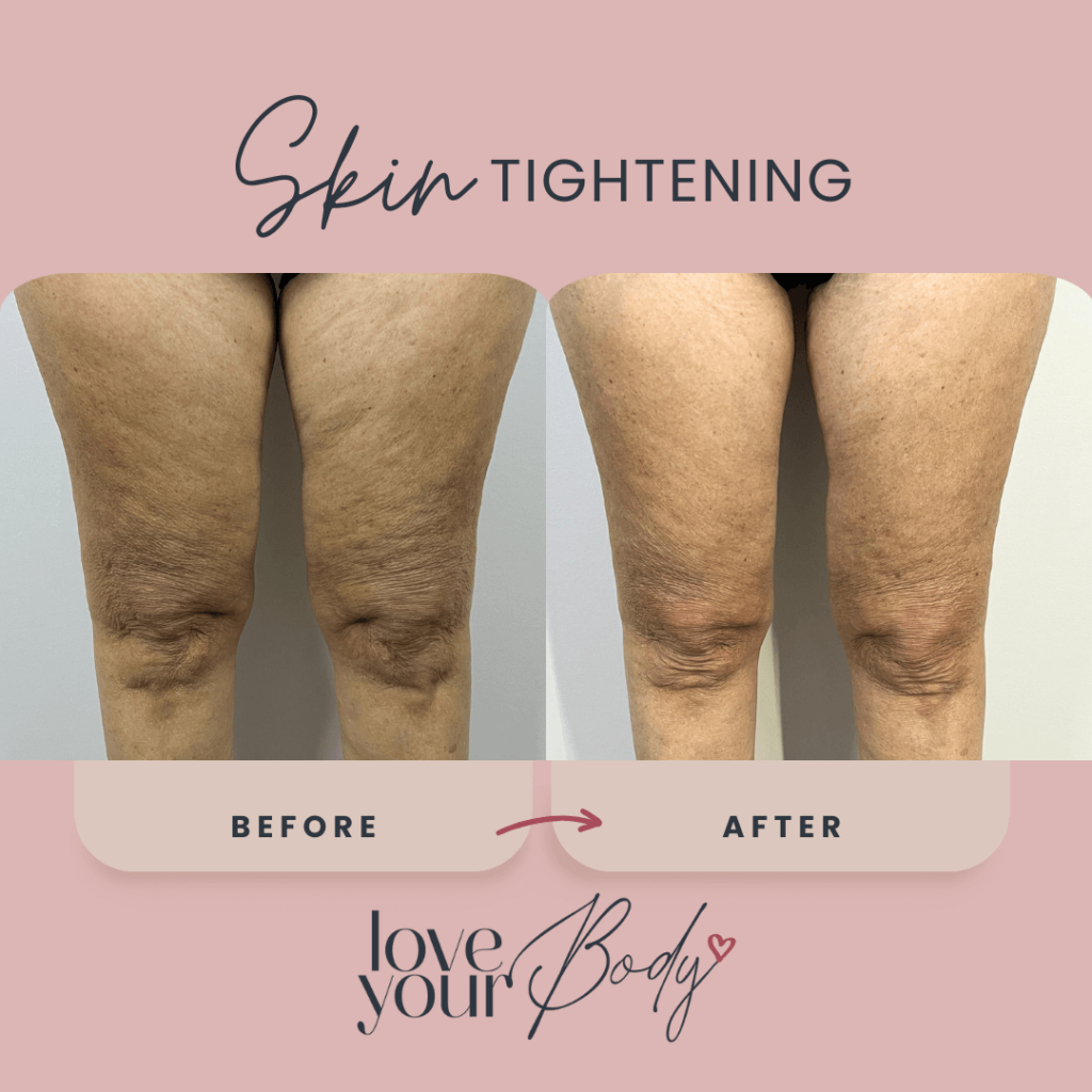 Body Sculpting Skin Tightening Before and After at Love Your Body in Clearwater 1