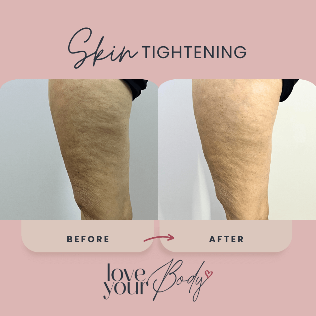 Body Sculpting Skin Tightening Before and After at Love Your Body in Clearwater 2