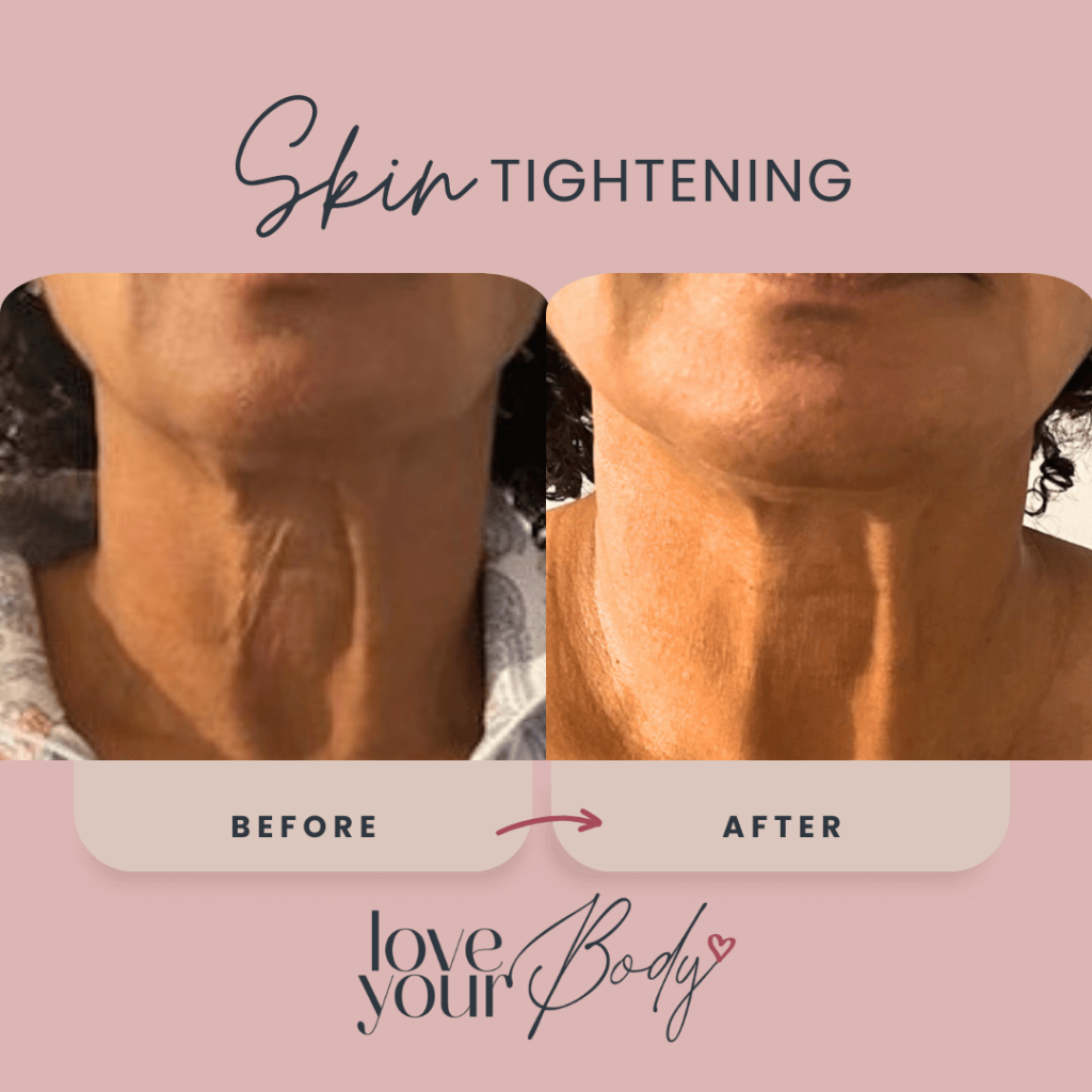 Body Sculpting Skin Tightening Before and After at Love Your Body in Clearwater 4