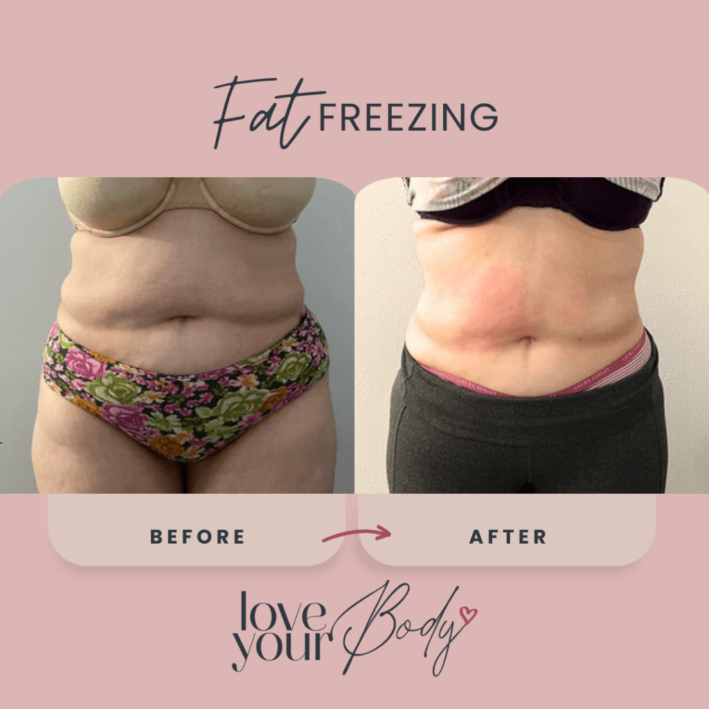 Body Sculpting Skin Tightening Before and After at Love Your Body in Clearwater 5