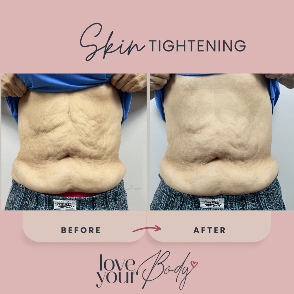 Body Sculpting Skin Tightening Before and After at Love Your Body in Clearwater 6