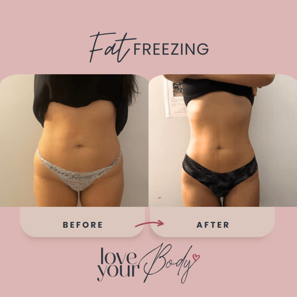 Body Sculpting Skin Tightening Before and After at Love Your Body in Clearwater 6