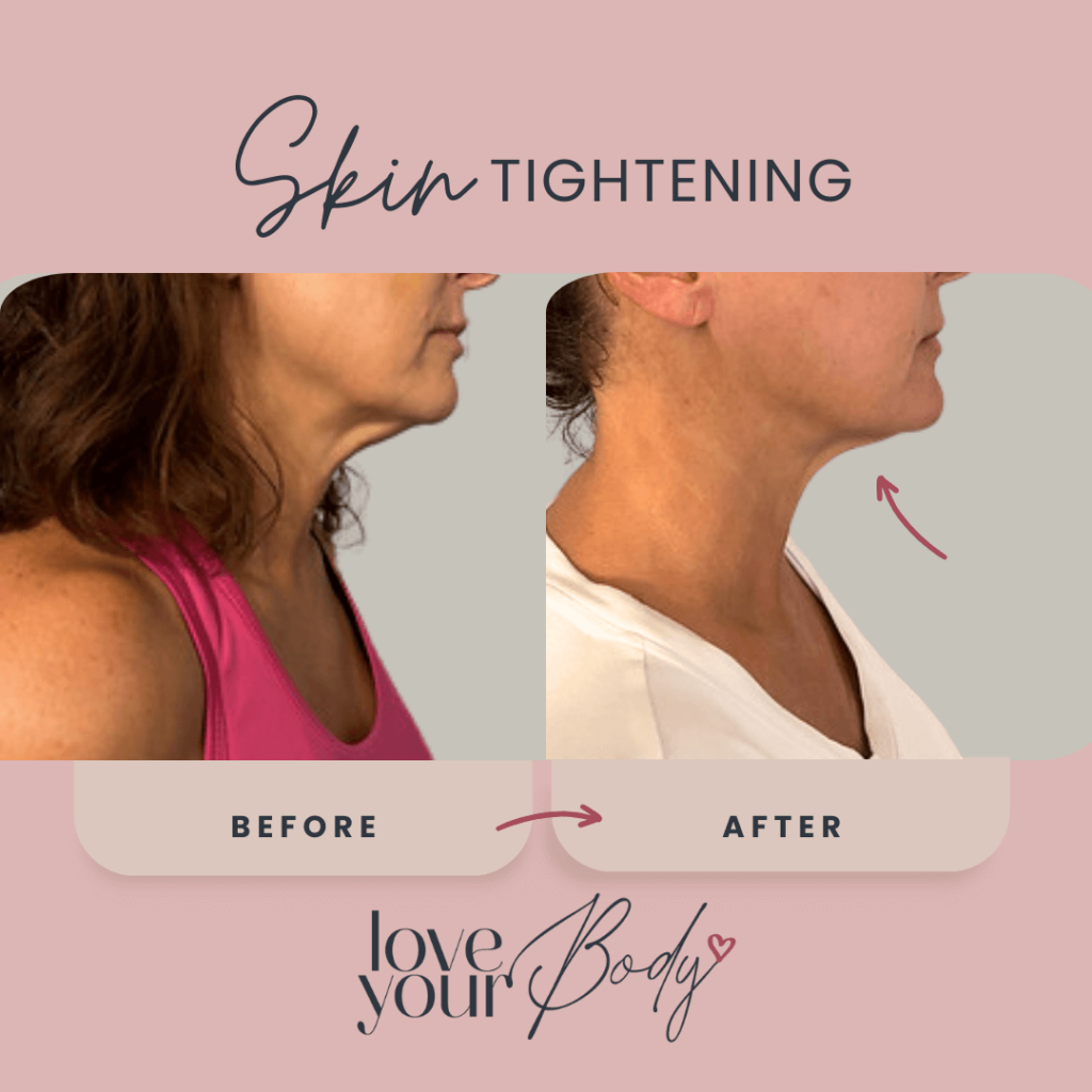 Body Sculpting Skin Tightening Before and After at Love Your Body in Clearwater 7