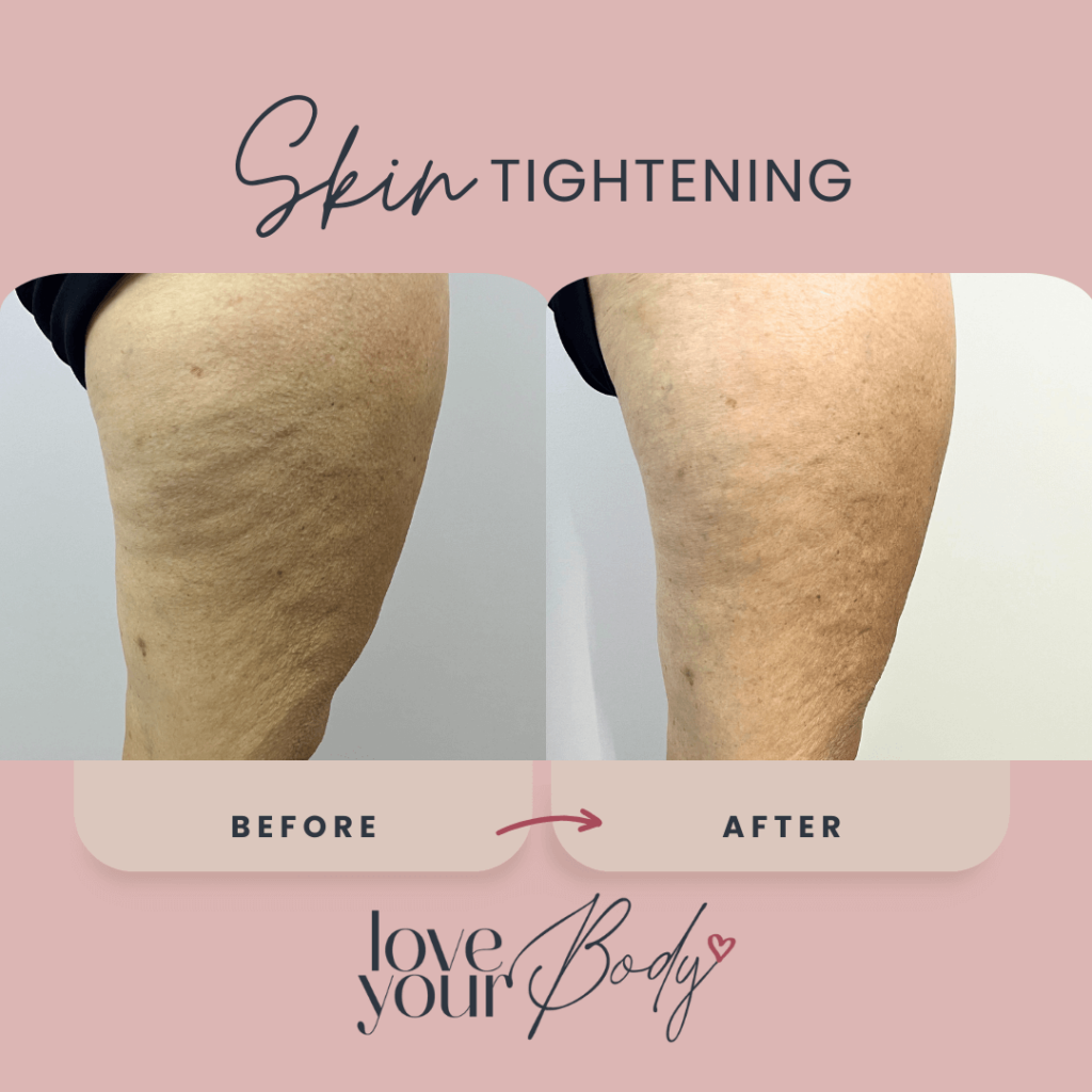 Body Sculpting Skin Tightening Before and After at Love Your Body in Clearwater2