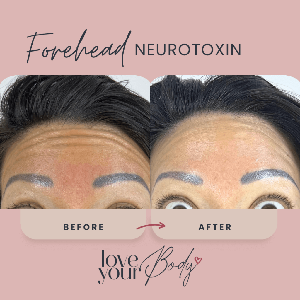Botox Forehead WrinklesBefore and After at Love Your Body in Clearwater 1