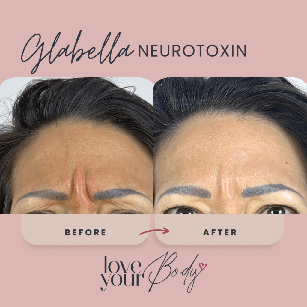 Botox Glabella Before and After at Love Your Body in Clearwater 1