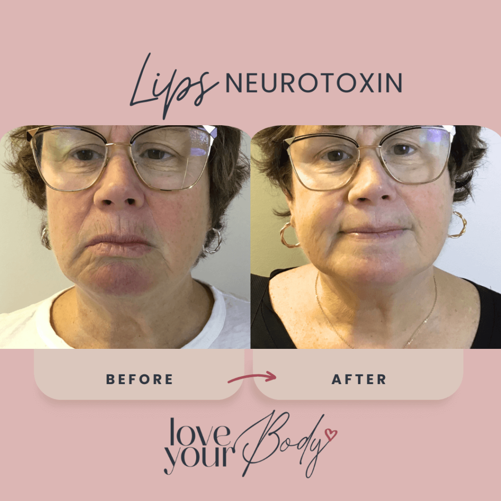 Botox Lip Lines Before and After at Love Your Body in Clearwater 1