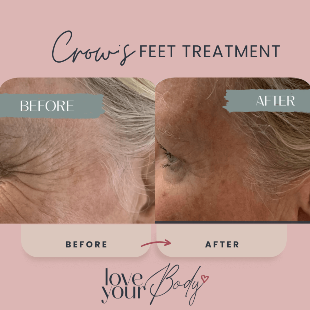 Crows Feet Wrinkle Treatment Before and After at Love Your Body in Clearwater 1