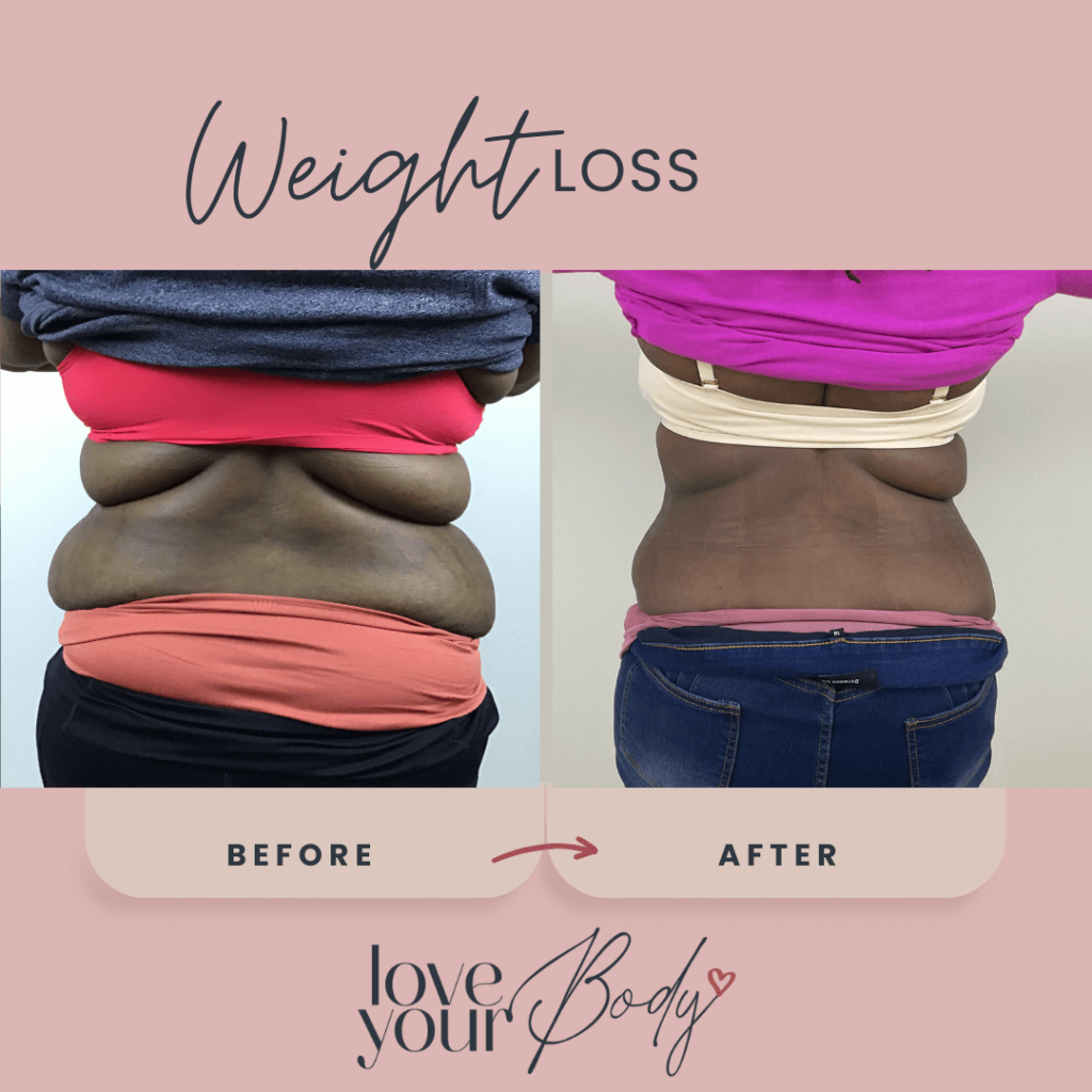 Medical Weight Loss GLP1 Before and After at Love Your Body in Clearwater