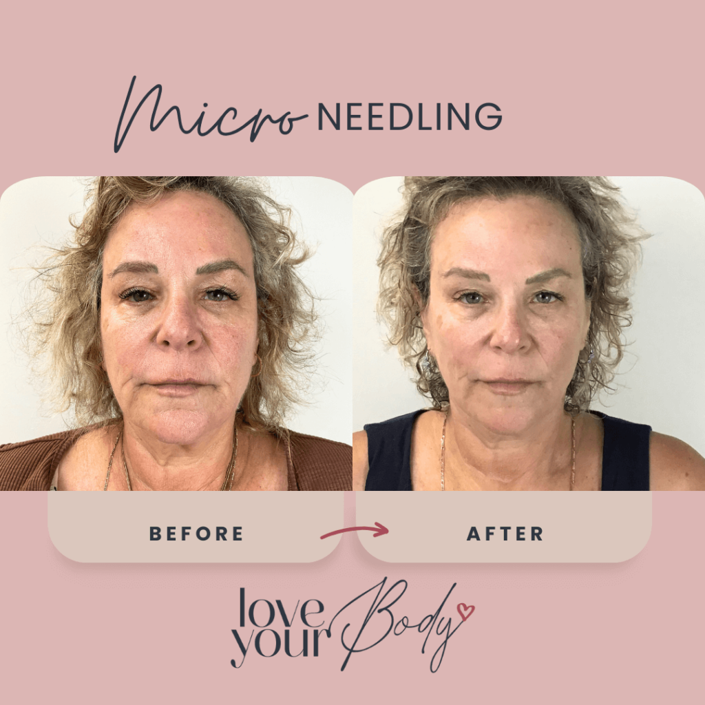 Microneedling Skin Care Before and After at Love Your Body in Clearwater