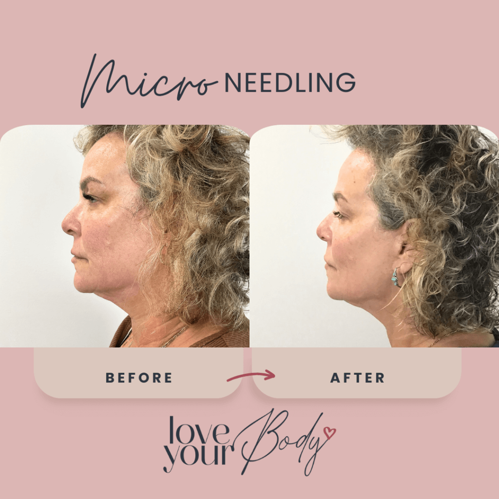 Microneedling Skin Care Before and After at Love Your Body in Clearwater2