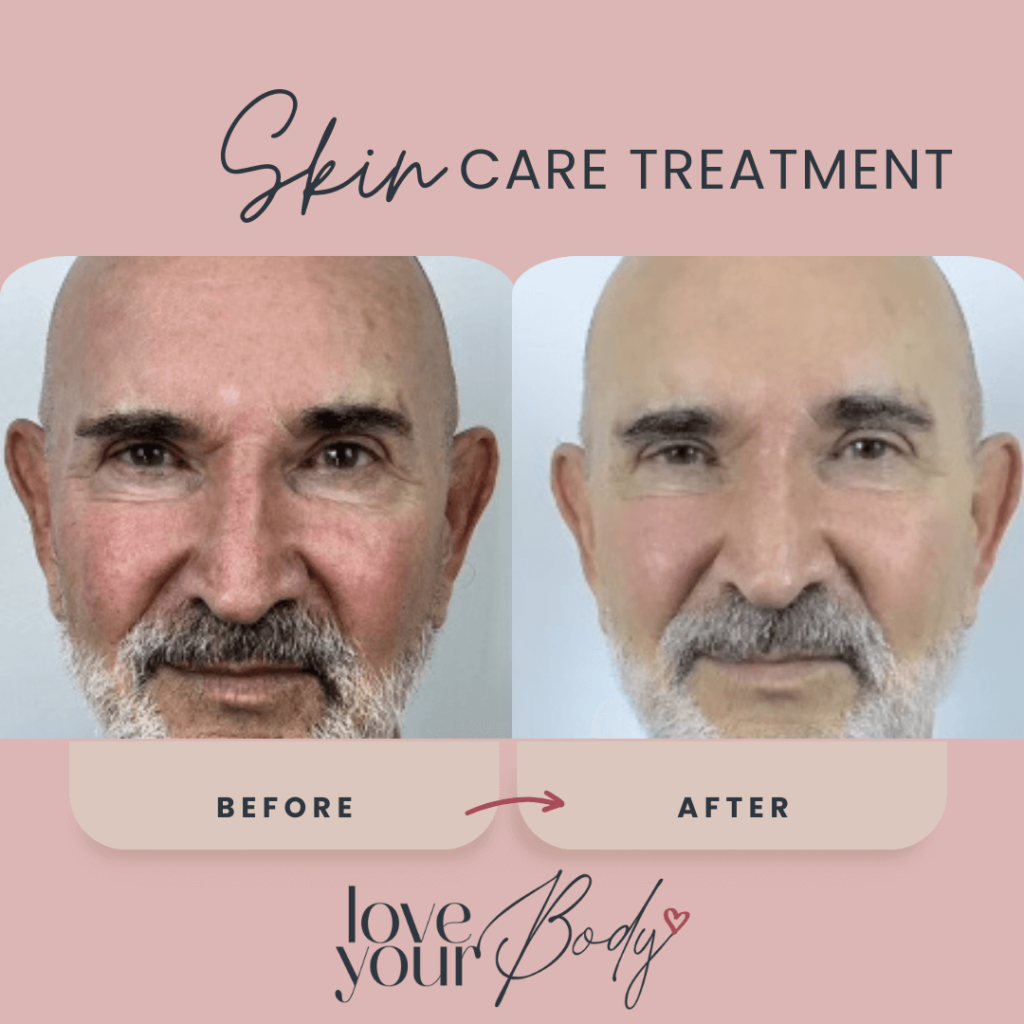 Skin Care Before and After at Love Your Body in Clearwater 7